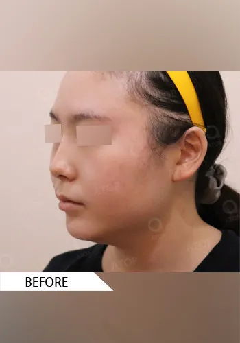 Before