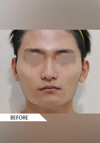 Before
