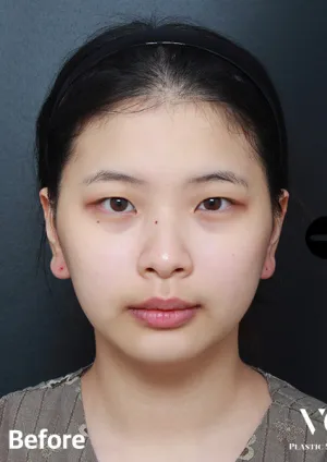 Before