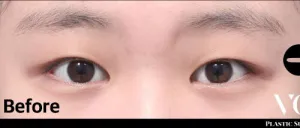 Before