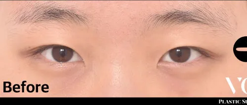 Before