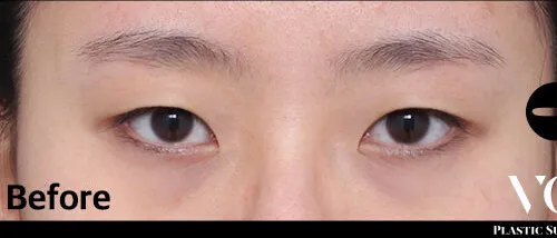 Before
