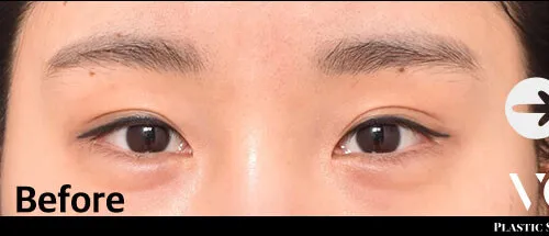 Before