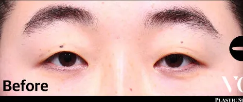 Before