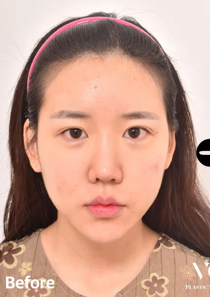 Before