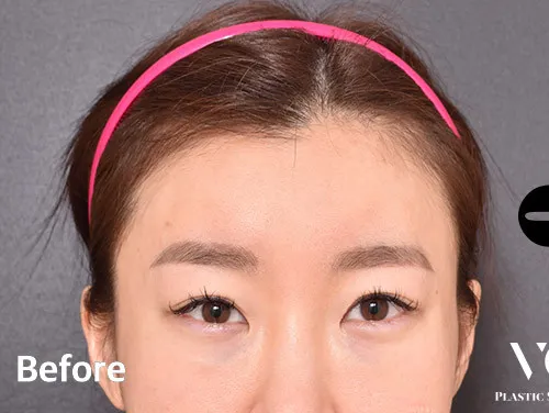 Before