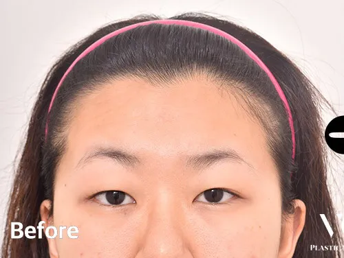 Before