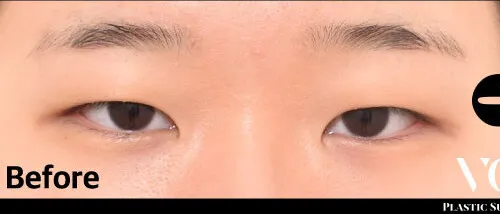 Before