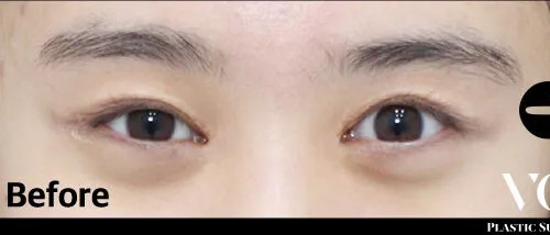 Before
