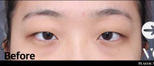 Before