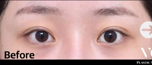 Before
