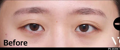 Before