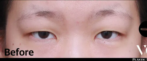 Before