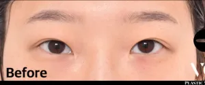 Before