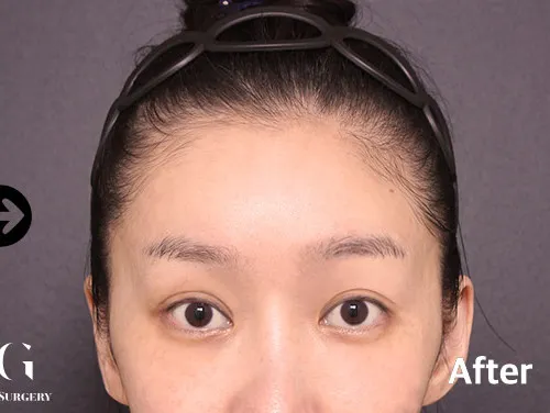 After