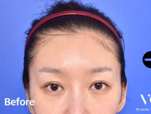 Before