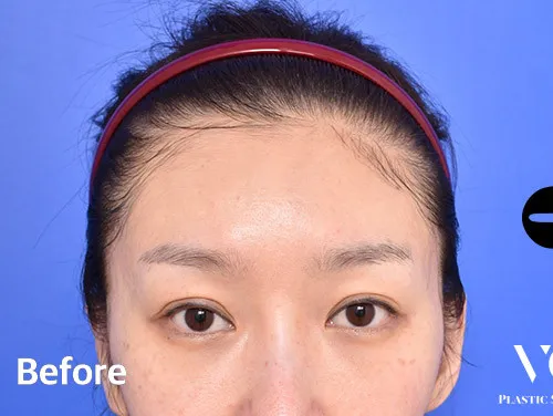 Before