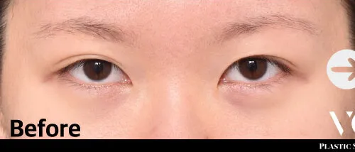 Before
