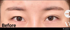 Before