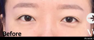 Before