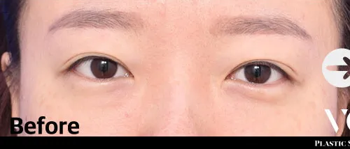Before