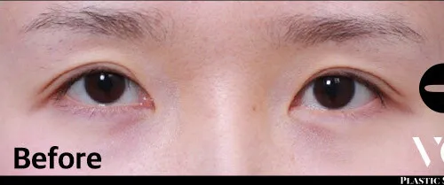 Before