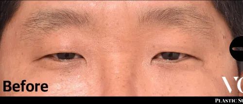 Before