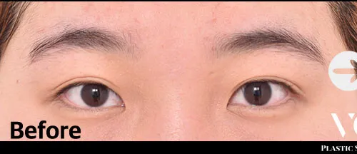 Before