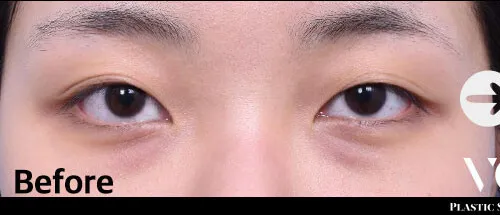 Before