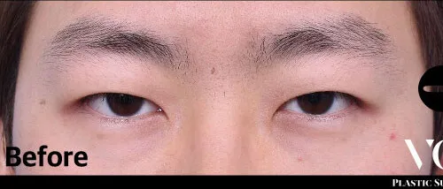 Before