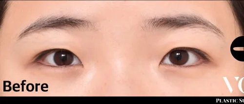 Before
