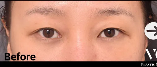 Before