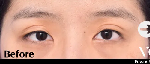 Before