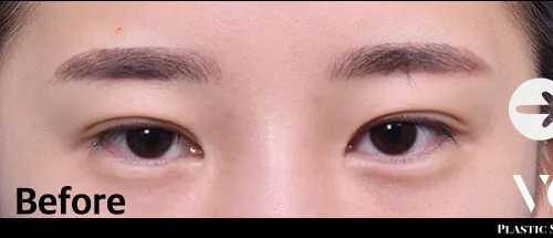 Before