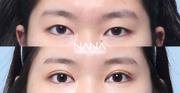 자연유착 (매몰) After