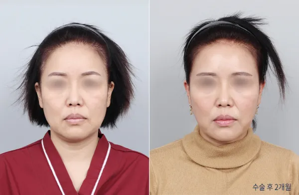 Before/After