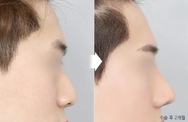Before/After