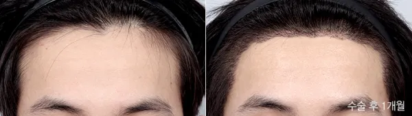 Before/After