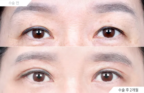 Before/After