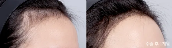 Before/After
