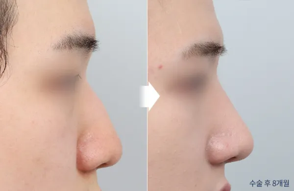 Before/After