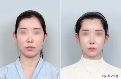 Before & After