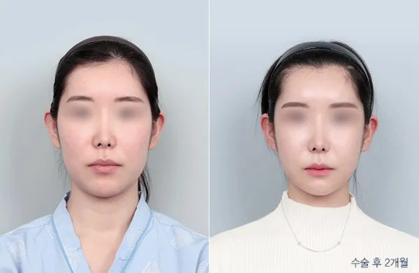 Before/After