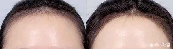 Before/After