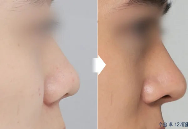 Before/After