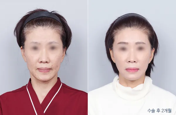 Before/After