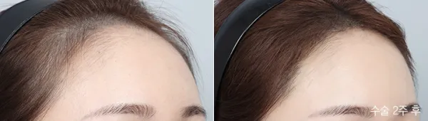 Before/After