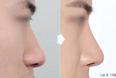 Before & After