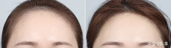 Before/After