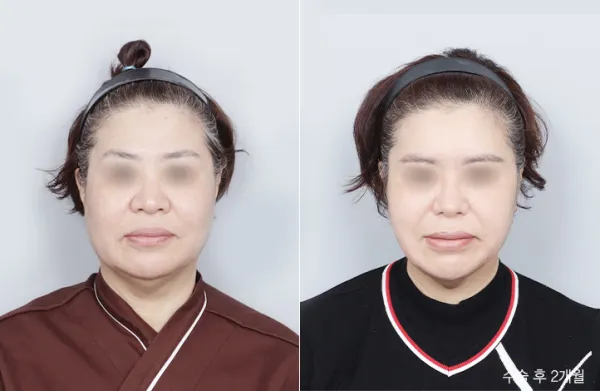 Before/After